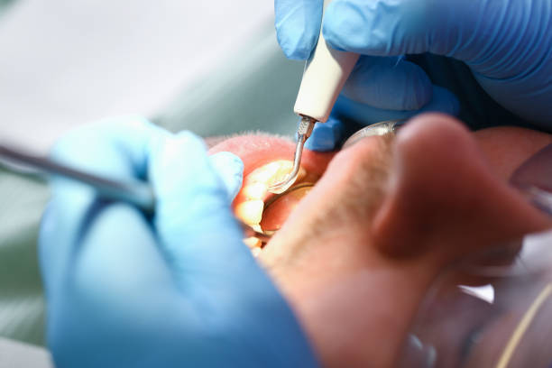 Best Emergency Dentist for Knocked-Out Tooth in Centennial, CO